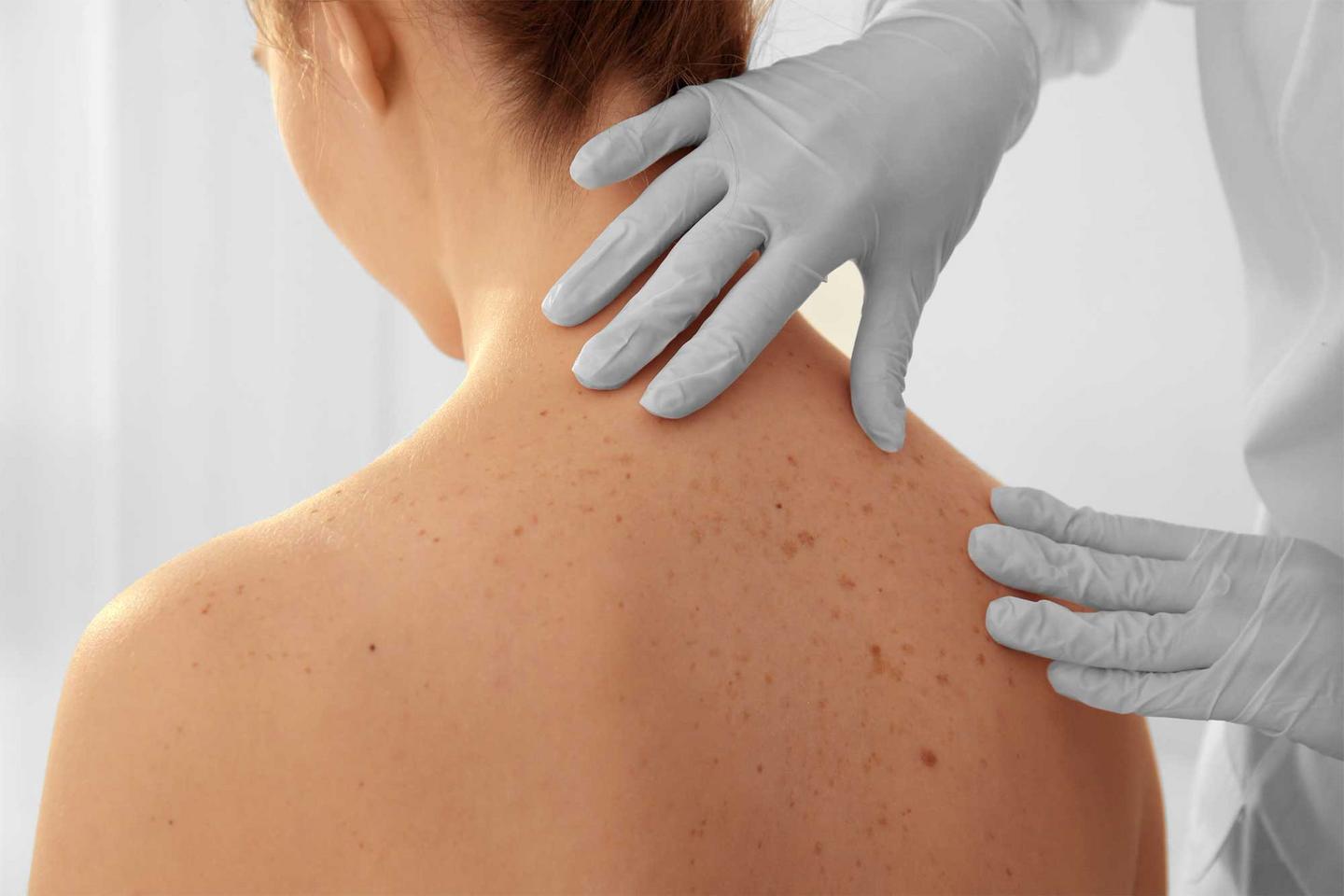 Hautärztin untersucht den Rücken einer Patientin zur Früherkennung von Hautkrebs