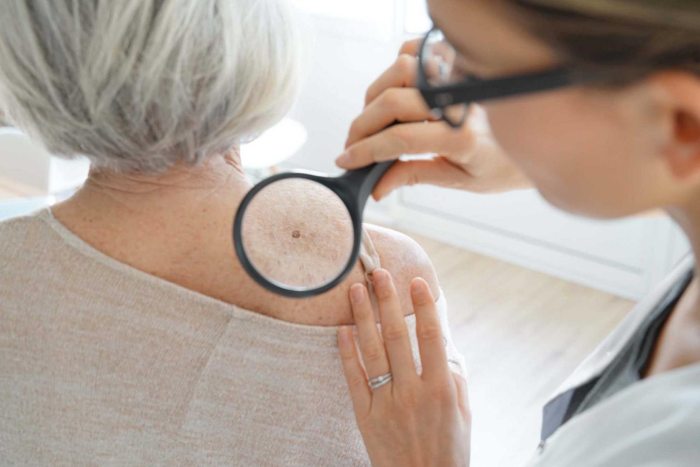 Hautkrebs-Screening: Ärztin betrachtet Muttermal einer Patientin mit der Lupe